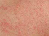Photos of Skin Heat Rash Treatment