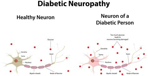 Diabetic Neuropathy Causes Symptoms Diagnosis And Treatment Natural