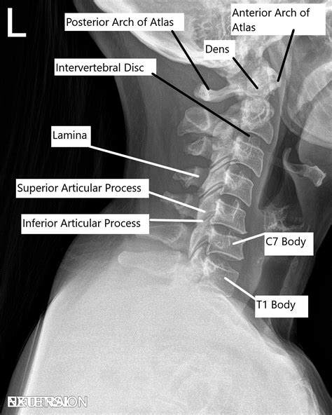 Posterior Cervical Fusion Complete Orthopedics Multiple Ny Locations