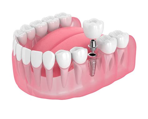 Teeth Replacement Options Island Dental Associates