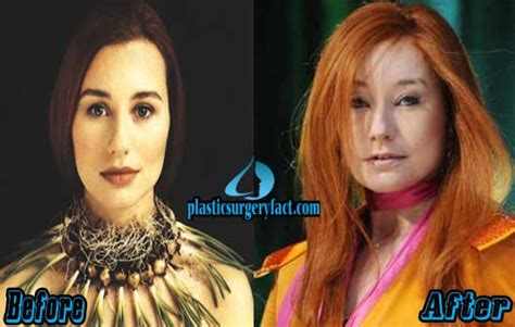 Tori Amos Plastic Surgery Before And After Photos