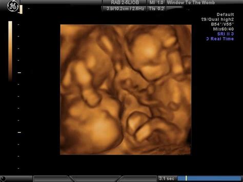 3d Ultrasound Scan Images Of 16 Week Twins Twins Ultrasound 16