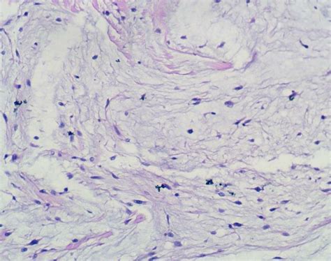 A Histology Fibro Myxoid Sarcoma 10x20 Hande Tumor Showing Myxoid
