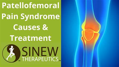 Patellofemoral Pain Syndrome Causes And Treatment Youtube