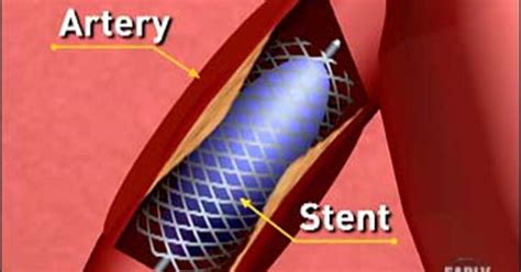 Can Drug Coated Stents Beat Bypass Cbs News