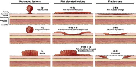 Table 2 From Colorectal Endoscopic Mucosal Resection Emr Semantic