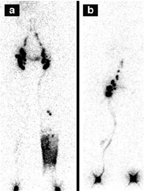 A Lymphoscintigraphy Findings Of A Patient At L Stage Iia Dermal