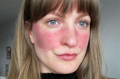 Rosacea How To Handle The Skin Condition Made Worse By Summer Rsvp Live