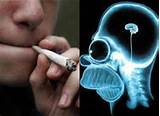 Marijuana Causes Brain Damage