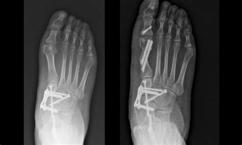 Embracing A Minimally Invasive Philosophy In Foot And Ankle Surgery