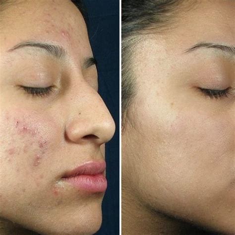 Chemical Peel And Microdermabrasion Fairfax Va Impressions Medspa