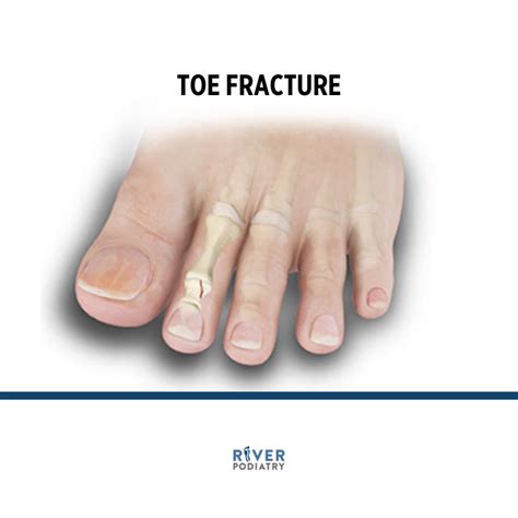 Toe Fractures — River Podiatry I The Best Foot And Ankle Care In Nynj