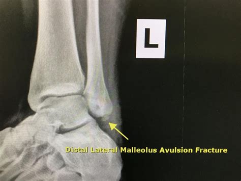 What Is Avulsion Fracture How To Prevent And Rehabilitate It — Best