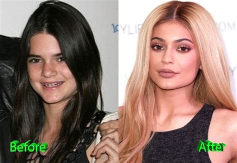 Kylie Jenner Plastic Surgery Before and After | Kylie ...