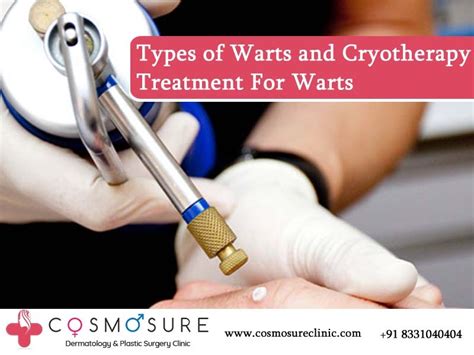Types Of Warts And Cryotherapy Treatment For Warts Cosmosure Clinic