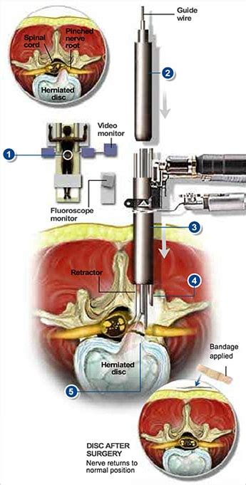 Microendoscopic Discectomy Surgery