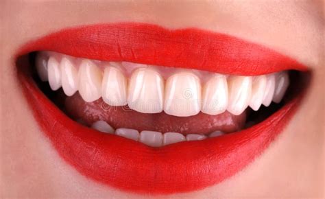 Perfect Healthy Teeth Beautiful Wide Smile Bleaching Procedure