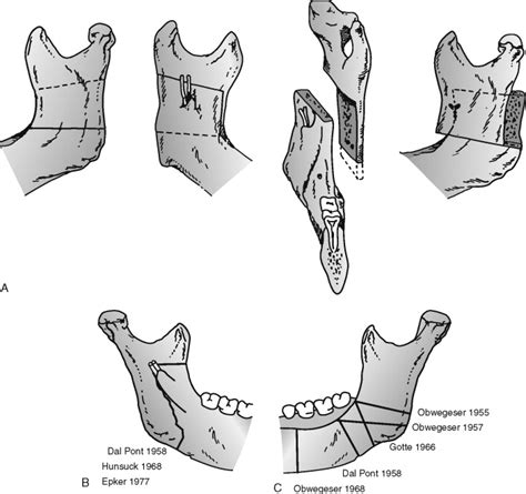 Sagittal Split Osteotomy Pocket Dentistry
