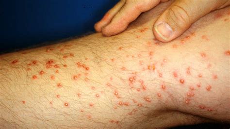 Mosquito Bites On Legs Red