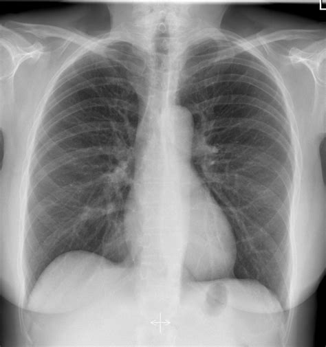 There is a degree of hyperinflation as evidenced by both increased retrosternal airspace and somewhat flattened and depressed diaphragms. NORMAL CHEST XRAY 5 | buyxraysonline
