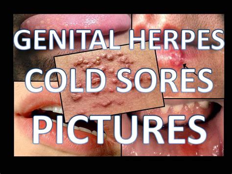 Genital Herpes Cold Sores Pictures YouTube