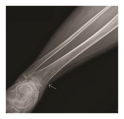 Nondisplaced Fracture At The Distal Right Tibial Metaphysis And Fibular