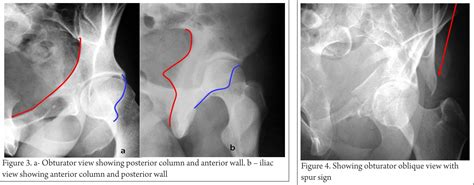 Management Of Acetabulum Fractures Basic Principles And