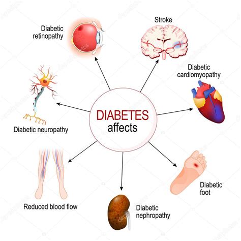 La diabetes afecta Complicaciones de la diabetes mellitus nefropatía