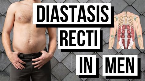 Diastasis Recti In Men Causes Symptoms Treatment Evolving World The