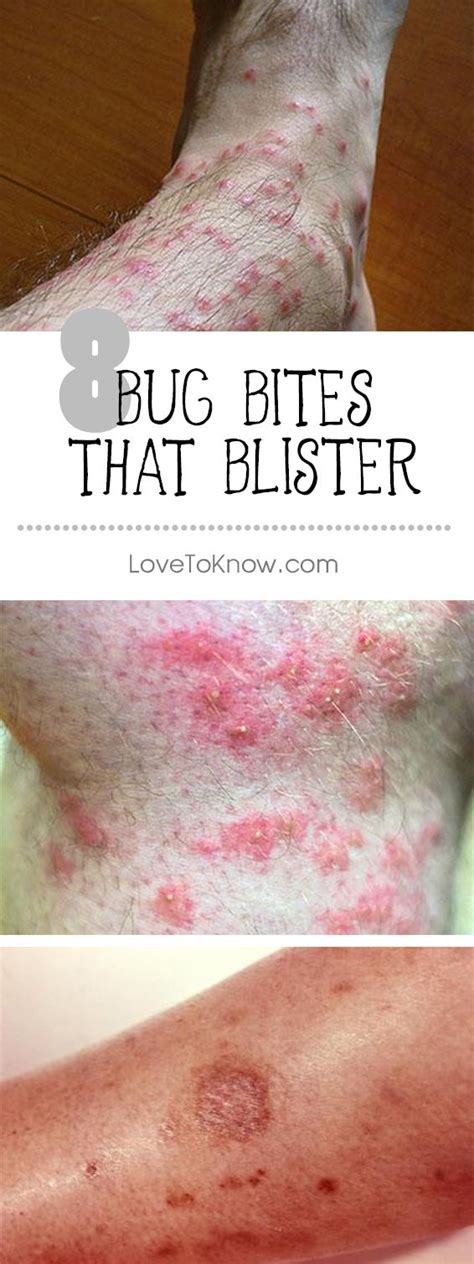 56 Best Of How To Treat Mosquito Bite Blisters Insectza