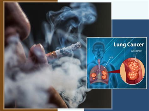 Can Tobacco Cause Lung Cancer Oncologist Explains Risk Factors