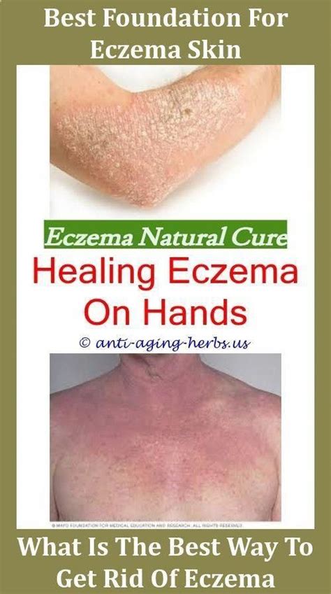 Eczemasolutions Eczema Cure Eczema Best Eczema Treatment