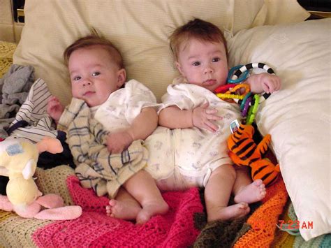 Conjoined Twins Separated At 7 Months Old In Risky Surgery Now Thriving