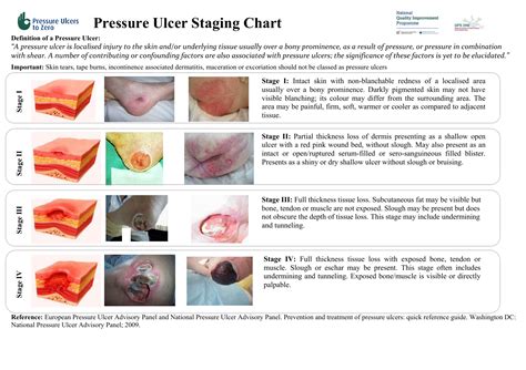 Pressure Ulcer Basics Module Understanding Pressure Ulcers My Xxx Hot