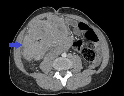 Cureus Diffuse Large B Cell Lymphoma In A Young Patient Presenting As