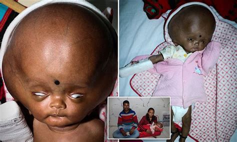 Indian Babys Head Tripled In Size Due To Hydrocephalus Daily Mail Online