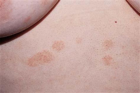 Parapsoriasis Small Plaque Type3 Dorothee Padraig South West Skin