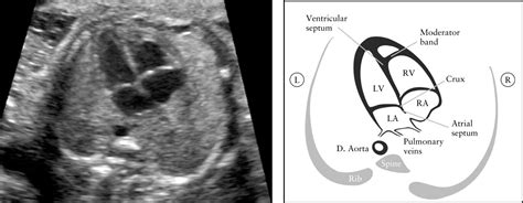 Isuog Practice Guidelines Updated Sonographic Screening Examination