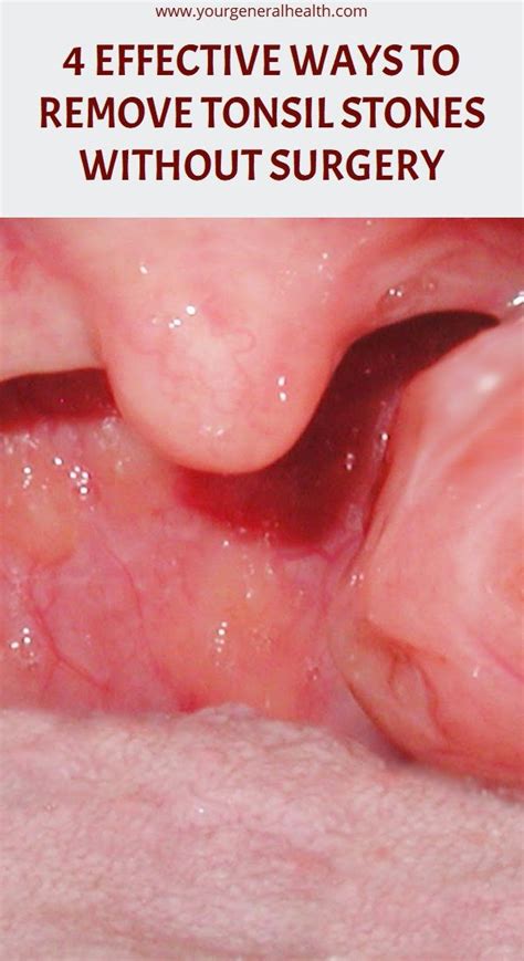 White Spots On My Tonsils Images And Photos Finder