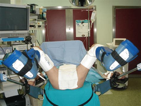 Simple Lithotomy Position Using Allen Stirrups And Sequential