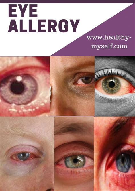 Eye Allergy Eye Allergy Symptoms And Home Remidies Details 2019 Puffyeyesallergies Eye Allergy