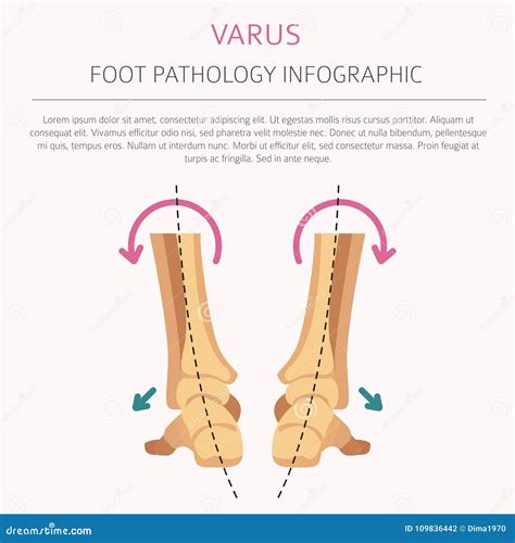 Foot Deformation As Medical Desease Infographic Valgus And Varus