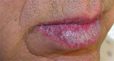 Lichen Planus Pictures Causes Symptoms Treatment Oral Healthmd