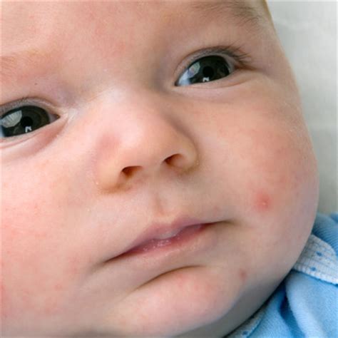 Eczema (dermatitis) one of the common reasons for a rash on the chest is contact dermatitis which may refer to skin inflammation or an adverse reaction to something that touches the skin. Baby Feeding Problems | What to Expect