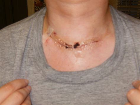 Thyroid Surgery Flickr Photo Sharing