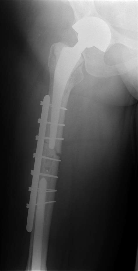 Plate And Dall Miles Cable Fixation Of Periprosthetic Fracture