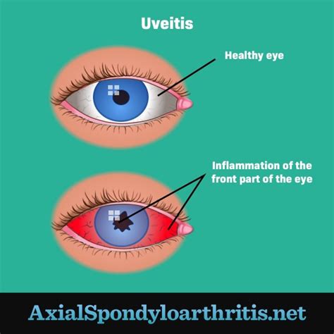 Uveitis And Eye Inflammation