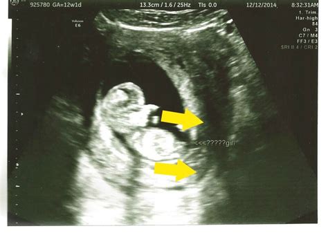 Twin pregnancy symptoms at 12 weeks. 12 Week Ultrasound Gender Reveal | Mother Rising | 12 week ...
