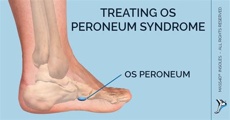 What Is Os Peroneum Syndrome Mass4d® Foot Orthotics