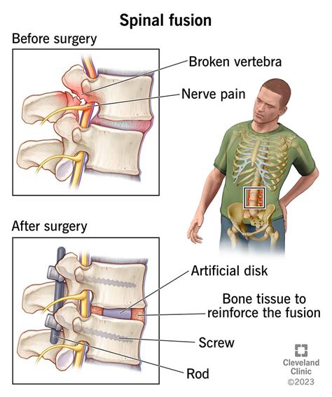 Spinal Fusion What It Is Purpose Procedure Risks And Recovery